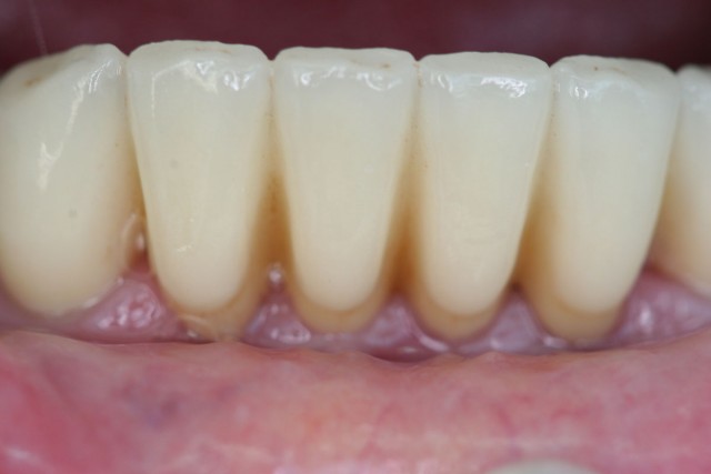 Terapia restauradora finalizada