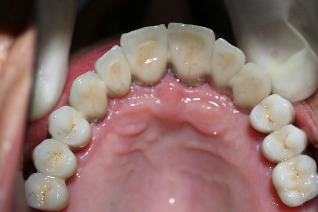 Este caso fue resuelto colocando 8 implantes en el maxilar superior y un puente fijo de cerámica que se aprecia en la fotografía.