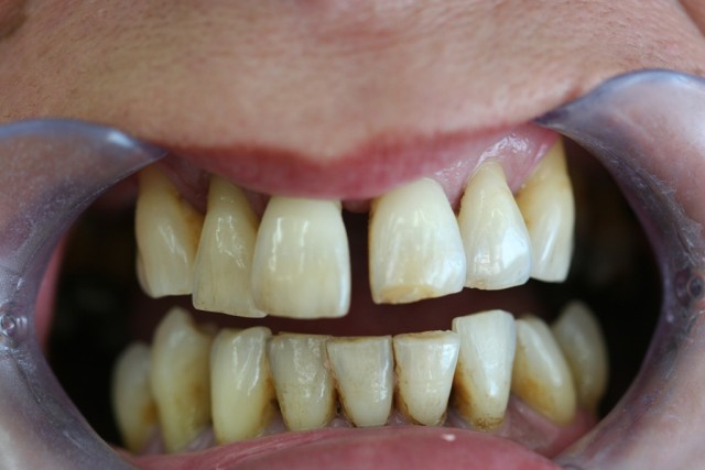 Before treatment/ Antes del tratamiento.
