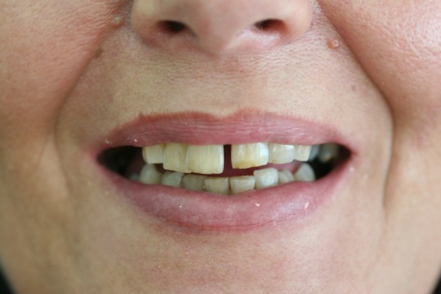 Before treatment/ Antes del tratamiento.