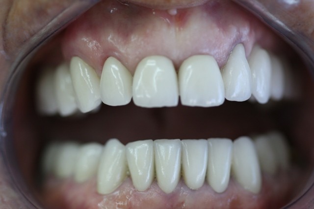 Tratamiento finalizado/ Finished treatment
