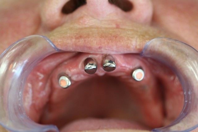 Shown in this picture are telescopic crowns that has a perfect match with the crowns in the protese 
