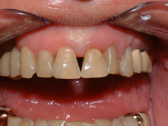 Detalle de los dientes antes del tratamiento 