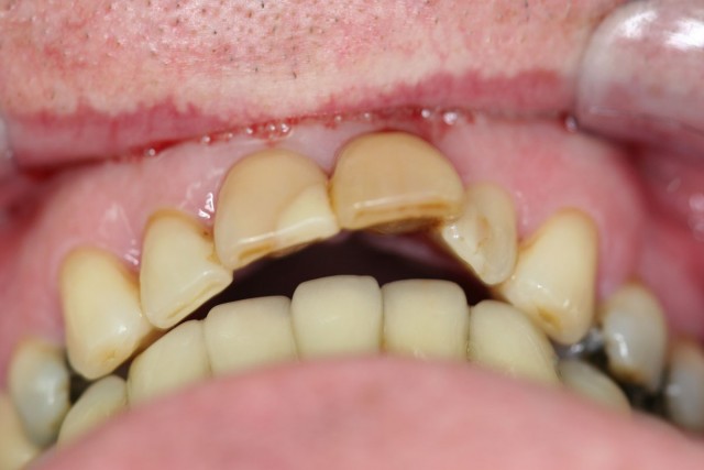 Esthetic and bite problems before the treatment.