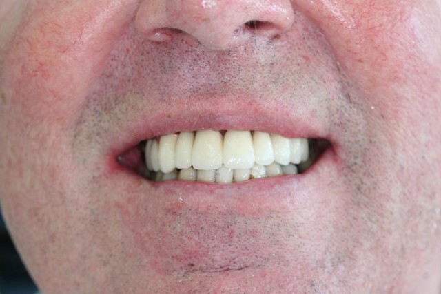 After treatment with metal(gold)-ceramic bridge.