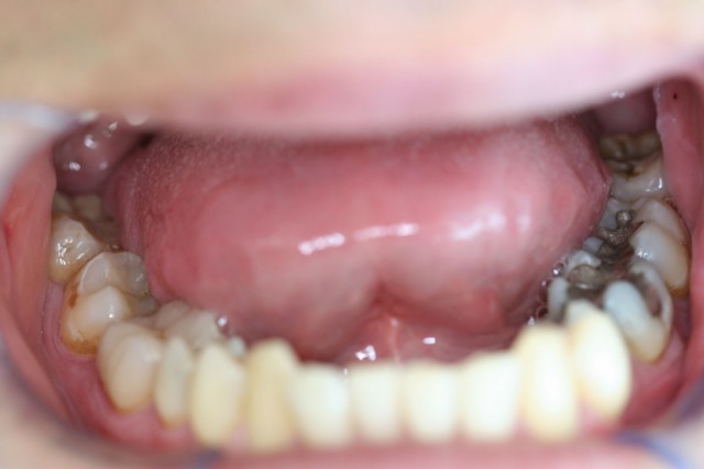 Vista a la derecha de empastes de amalgama y a la izquierda empastes del mismo color del diente libres de amalgama