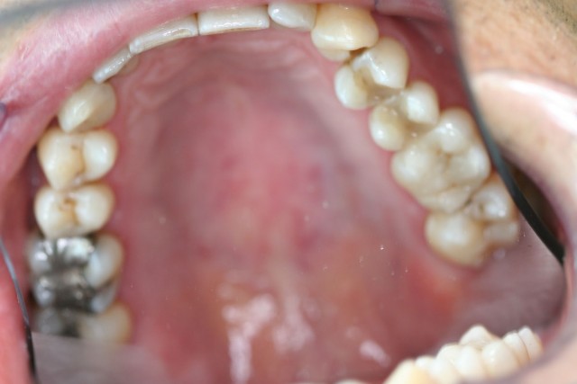 Arcada superior a la derecha empastes del mismo color del diente, a la izquierda empaste de amalgama.