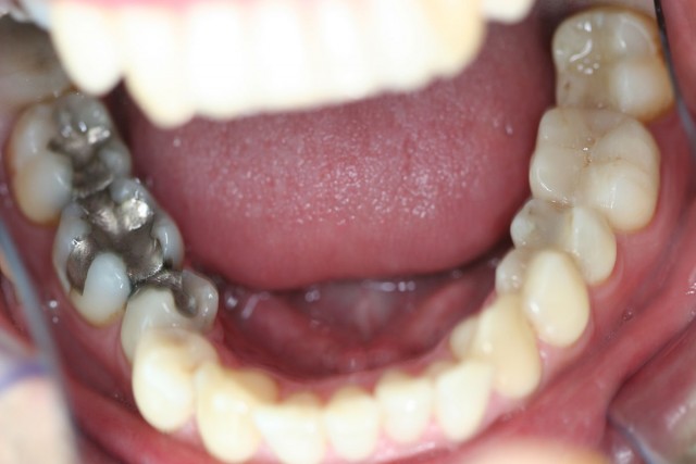 Detail of the difference between amalgam filling and white fillings.