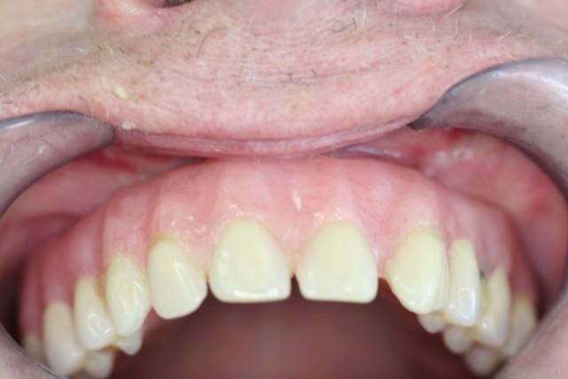 Detalle de prótesis en boca con novedoso sistema de implantes all-on-4