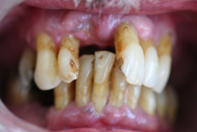 Front view of the teeth before the treatment with implants.