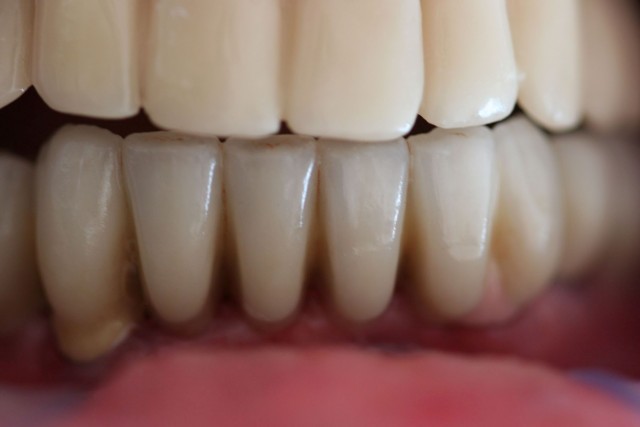  Ceramic bridges and crowns placed over the implants.